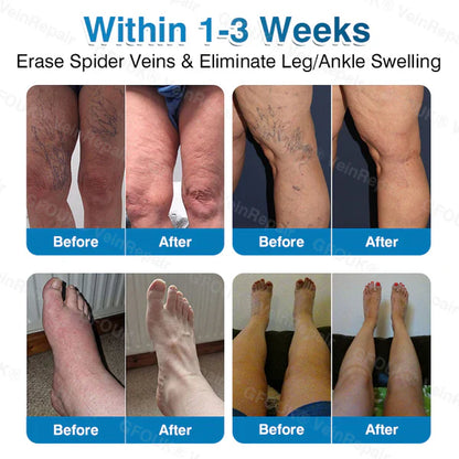 LUNOON® US✅🌱 VeinRepair Microneedle Patch Roll ⚡ Instant Relief, Long-Term Results