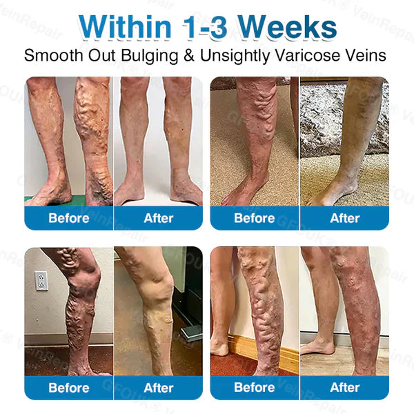 LUNOON® US✅🌱 VeinRepair Microneedle Patch Roll ⚡ Instant Relief, Long-Term Results