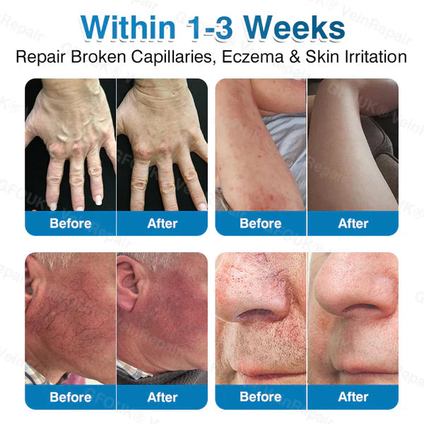 LUNOON® US✅🌱 VeinRepair Microneedle Patch Roll ⚡ Instant Relief, Long-Term Results
