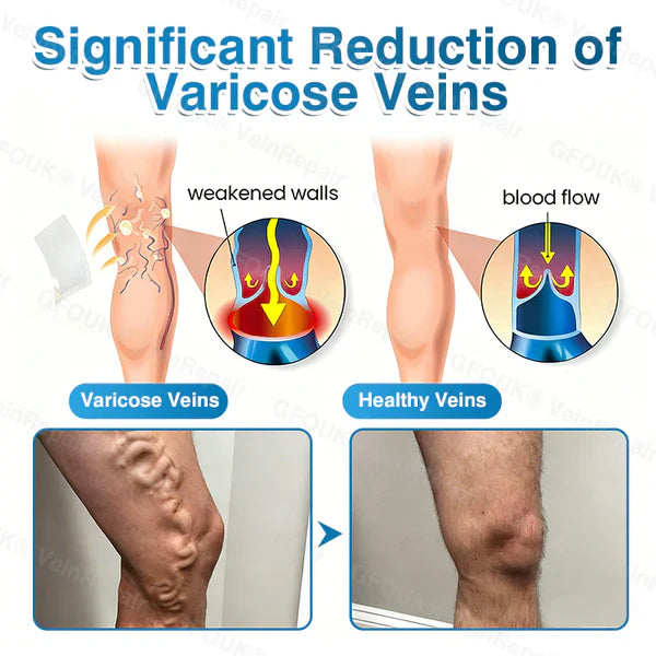 LUNOON® US✅🌱 VeinRepair Microneedle Patch Roll ⚡ Instant Relief, Long-Term Results