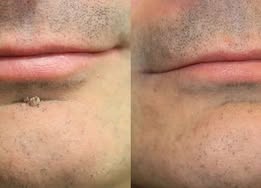 🔥NEYEROS®2-in-1 Microneedle & Hydrocolloid Patch🍀| Removes Raised Moles, Acne, Flat Warts & Skin Tags | Helps Improve Wrinkles, Scars & Blemishes | Invisible Patches for Face & Body