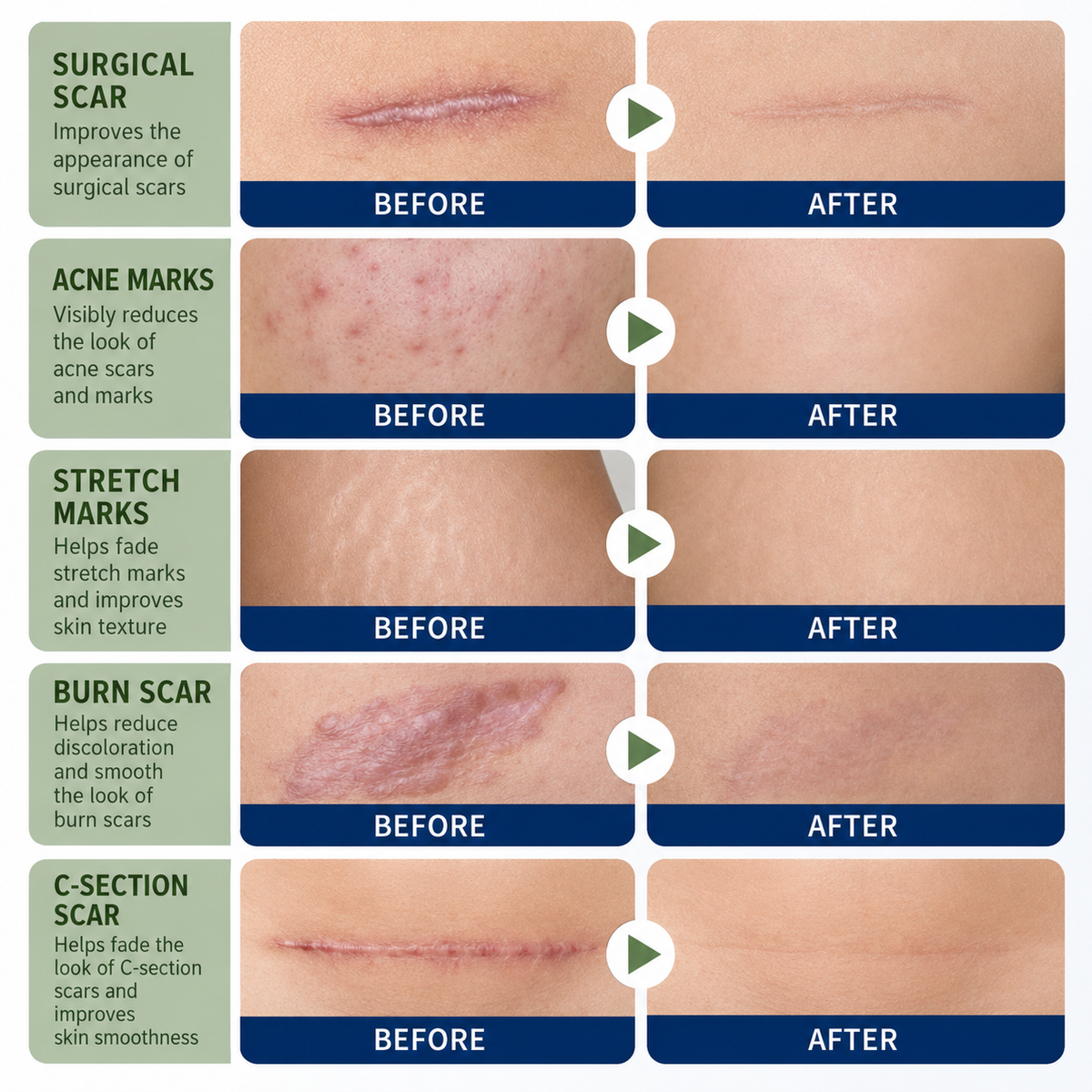 ✨ SILICONE SCAR GEL — Flatten. Soften. Fade.-Q1