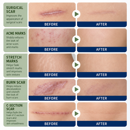 ✨ SILICONE SCAR GEL — Flatten. Soften. Fade.-Q1
