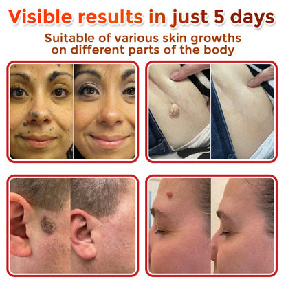 🗽✅GFOUK® MicroNeedle Botanic Skin Tag Removal Patch 🇺🇸 Made in the USA