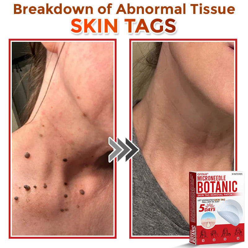 🗽✅GFOUK® MicroNeedle Botanic Skin Tag Removal Patch 🇺🇸 Made in the USA