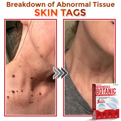 🗽✅GFOUK® MicroNeedle Botanic Skin Tag Removal Patch 🇺🇸 Made in the USA