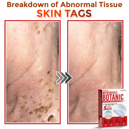 🗽✅GFOUK® MicroNeedle Botanic Skin Tag Removal Patch 🇺🇸 Made in the USA