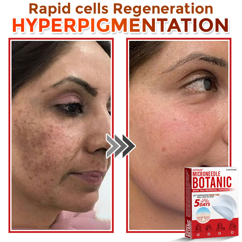 🗽✅GFOUK® MicroNeedle Botanic Skin Tag Removal Patch 🇺🇸 Made in the USA