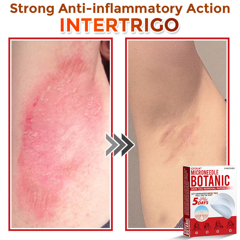 🗽✅GFOUK® MicroNeedle Botanic Skin Tag Removal Patch 🇺🇸 Made in the USA