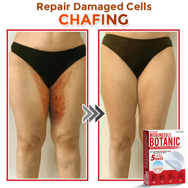 🗽✅GFOUK® MicroNeedle Botanic Skin Tag Removal Patch 🇺🇸 Made in the USA