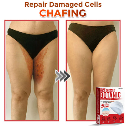 🗽✅GFOUK® MicroNeedle Botanic Skin Tag Removal Patch 🇺🇸 Made in the USA