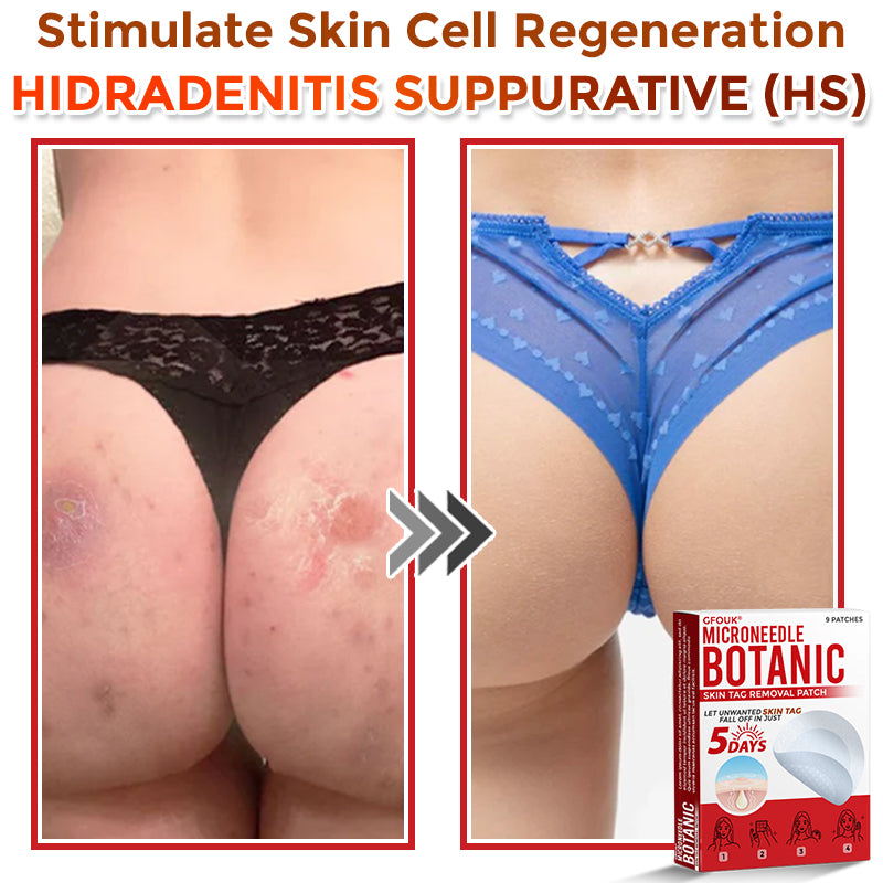 🗽✅GFOUK® MicroNeedle Botanic Skin Tag Removal Patch 🇺🇸 Made in the USA