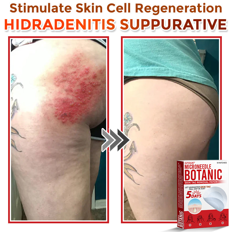 🗽✅GFOUK® MicroNeedle Botanic Skin Tag Removal Patch 🇺🇸 Made in the USA