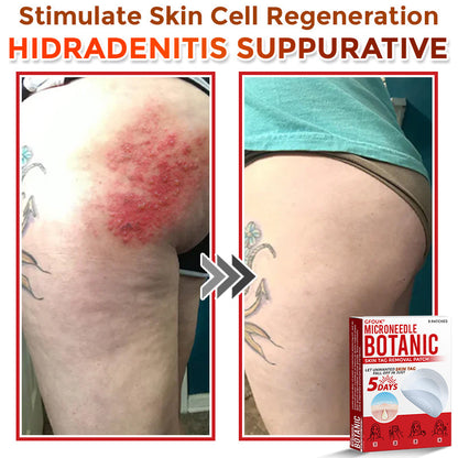 🗽✅GFOUK® MicroNeedle Botanic Skin Tag Removal Patch 🇺🇸 Made in the USA