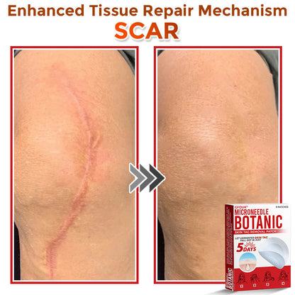 🗽✅GFOUK® MicroNeedle Botanic Skin Tag Removal Patch 🇺🇸 Made in the USA