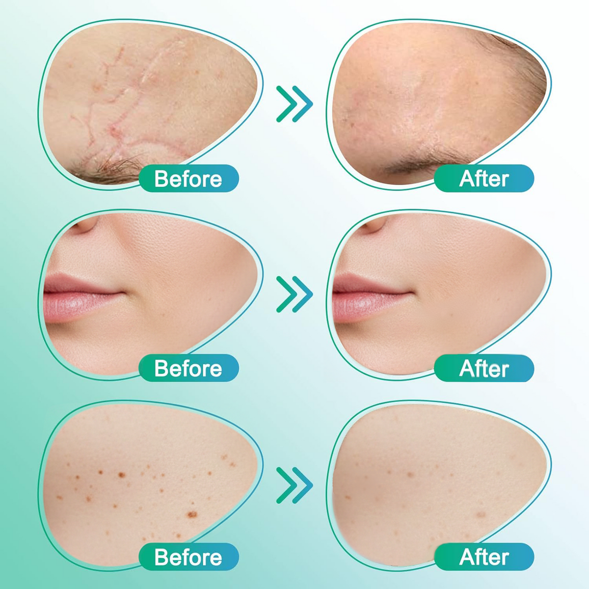 CareBreeze® 3-in-1 Scar Removal Microneedle Care Patch 💡