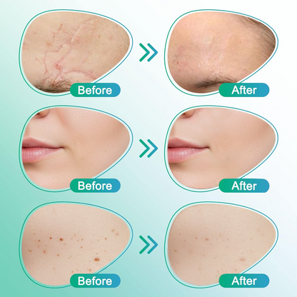 CareBreeze® 3-in-1 Scar Removal Microneedle Care Patch 💡