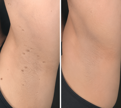 🔥NEYEROS®2-in-1 Microneedle & Hydrocolloid Patch🍀| Removes Raised Moles, Acne, Flat Warts & Skin Tags | Helps Improve Wrinkles, Scars & Blemishes | Invisible Patches for Face & Body