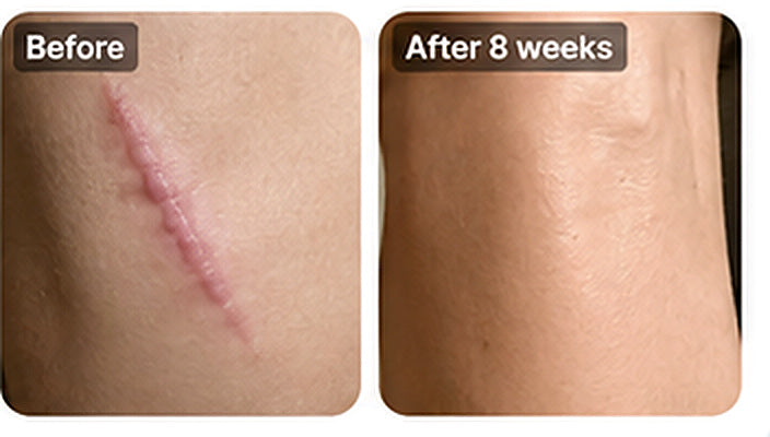 ✨ SILICONE SCAR GEL — Flatten. Soften. Fade.-Q1