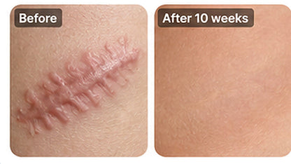 ✨ SILICONE SCAR GEL — Flatten. Soften. Fade.-Q1