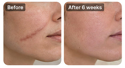 ✨ SILICONE SCAR GEL — Flatten. Soften. Fade.-Q1